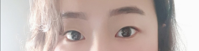 [Mắt] 라비라비옹 - Cắt mí (phẫu thuật cắt)