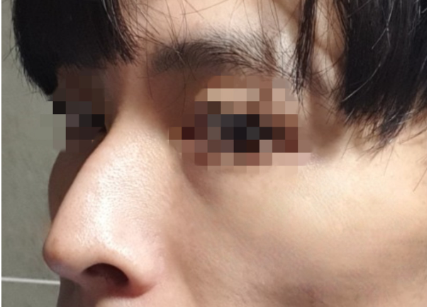 [Хамрын] Хамрын мэс засал - Хамар