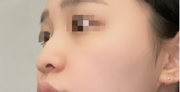 [Хамрын] Бөөрөнхий хамар - Хамар