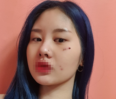 [Mắt] Bác sĩ tuyệt vời nhất - Mắt, hút mỡ mặt