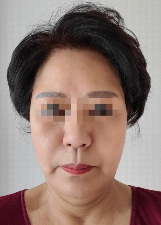 [Chống lão hóa] Acacia - Phẫu thuật căng da mặt