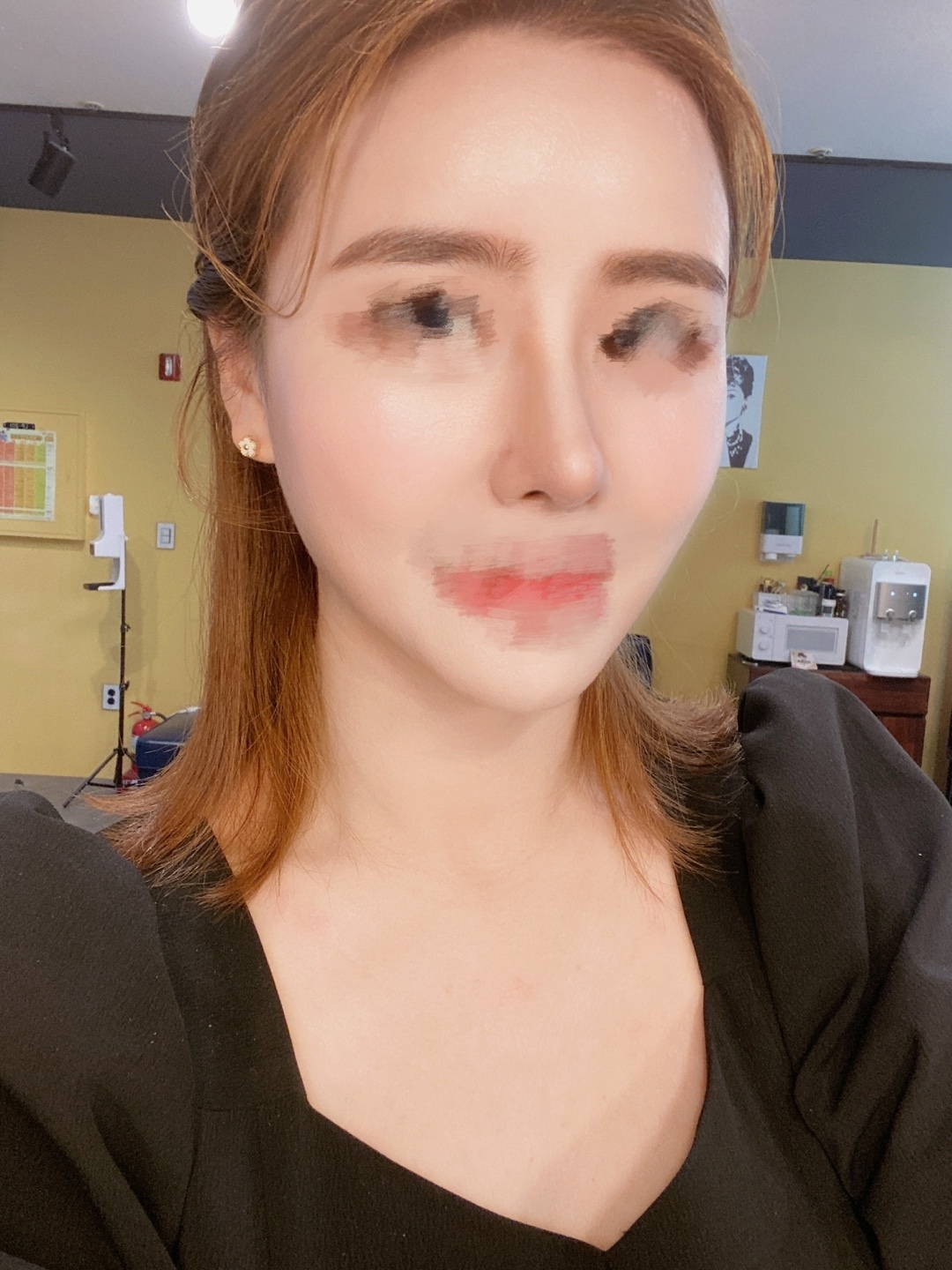 [Chống lão hóa] Hỏi đáp - Cấy mỡ toàn mặt, mũi