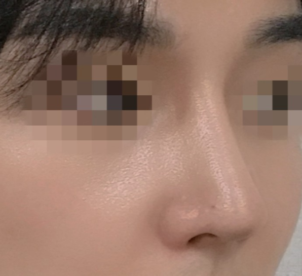 [Хамрын мэс засал] Нанын Келли - Хамар