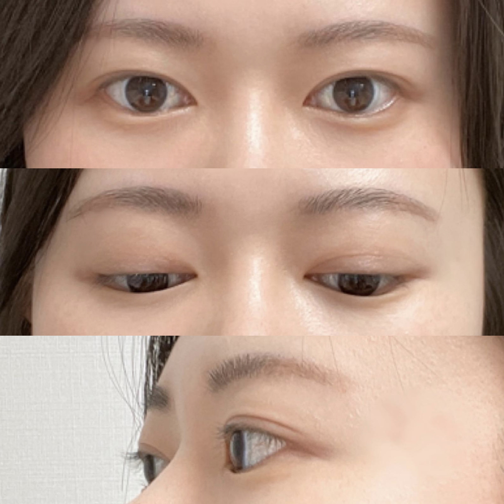 Đánh giá sau khi nhấn mí và chỉnh sửa mắt