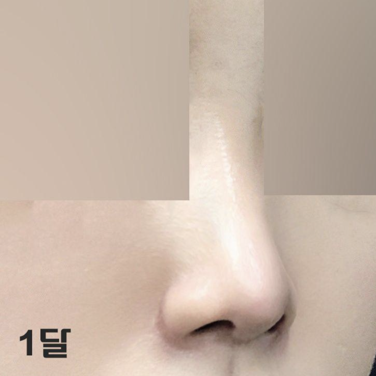 Sau một tháng, có vẻ như tình trạng sưng tấy giảm đi nhiều hơn nữa ~