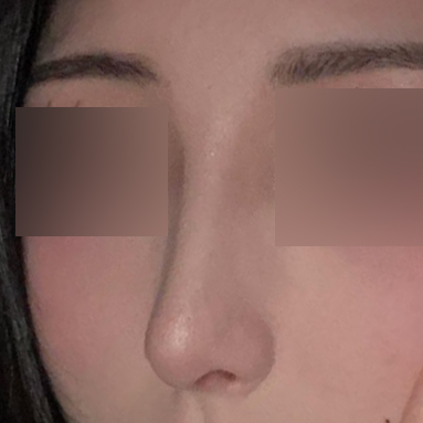 Mình đã quyết định phẫu thuật vì quá căng thẳng với chiếc mũi khoằm!!