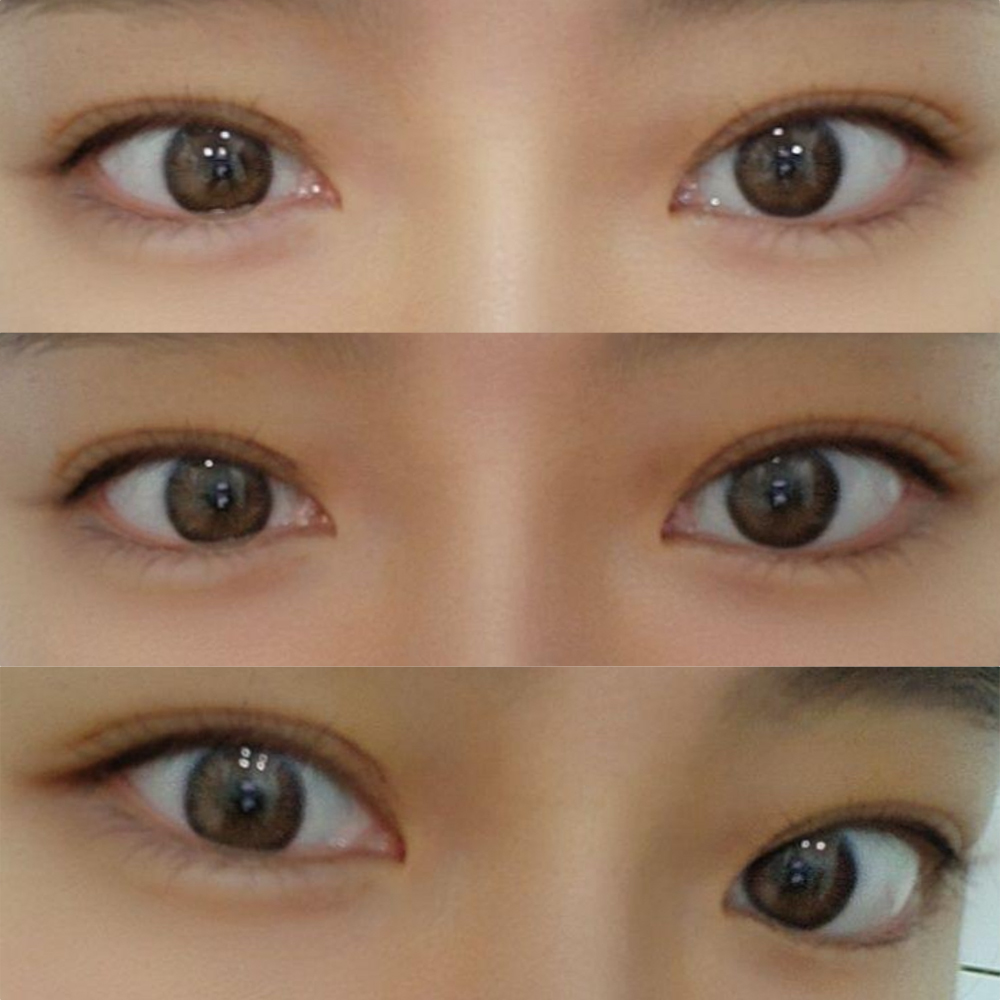 Би Сим Жон Хван эмчид зовхины хагалгаагүй нүдний хэлбэр засуулсан!