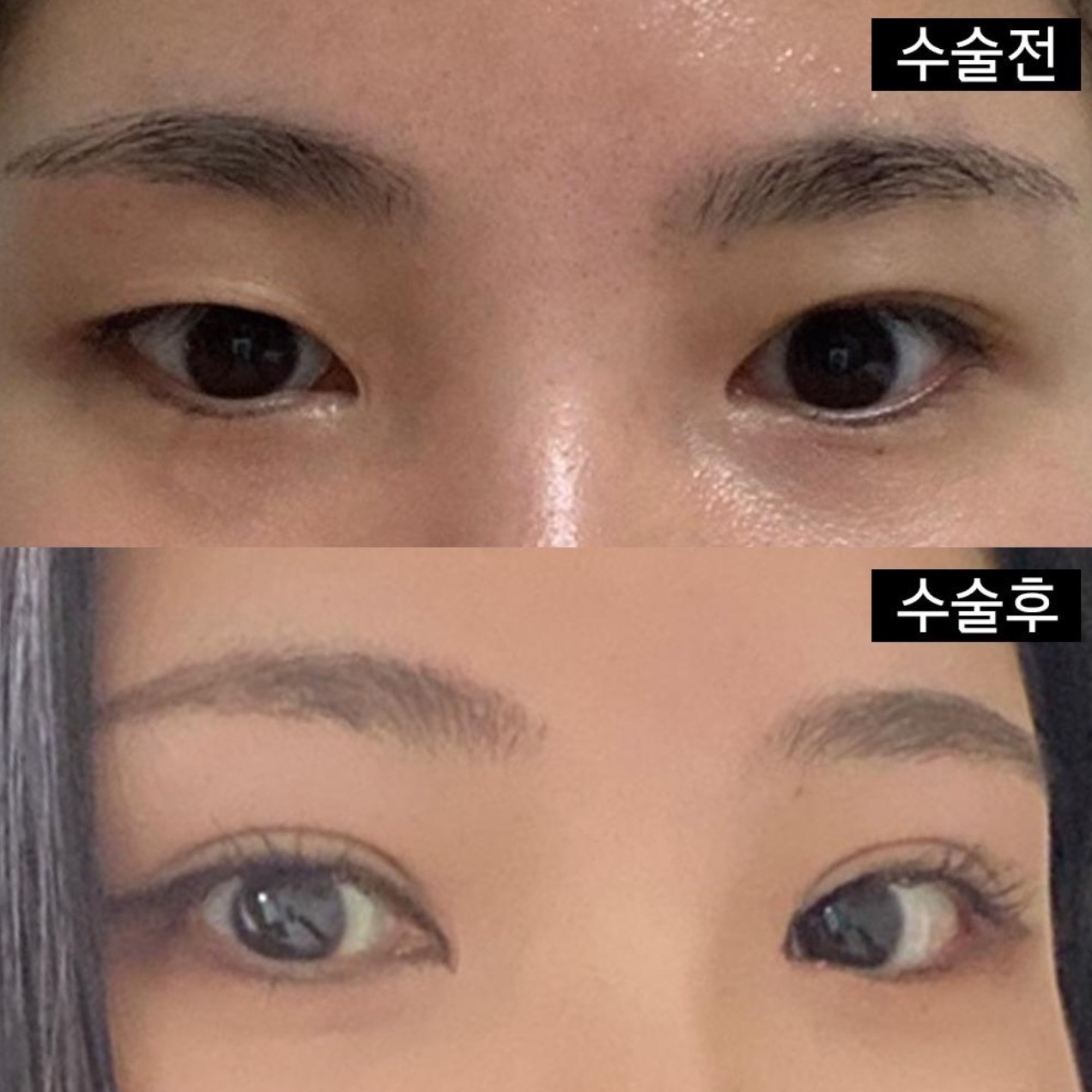 Nếu bạn đang có ý định cắt mí hoặc tái phẫu thuật mắt thì mình rất khuyến khích bạn đến đây