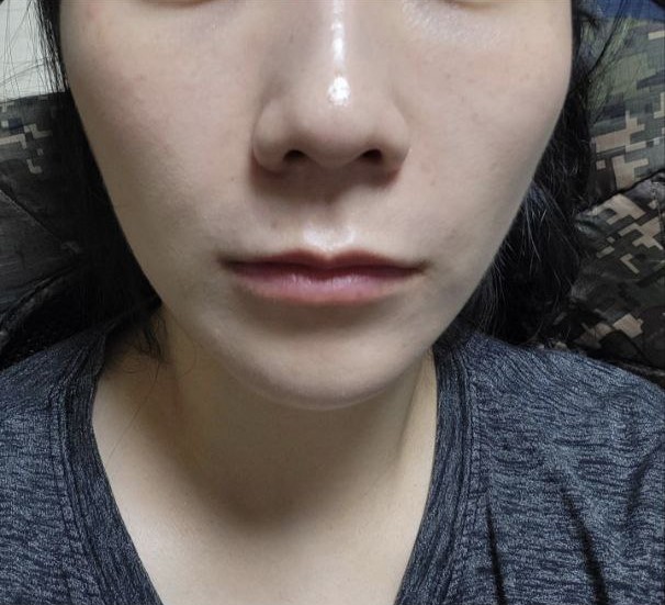 Xem tay nghề bác sĩ, mình nghĩ không cần phải lo lắng gì cả.