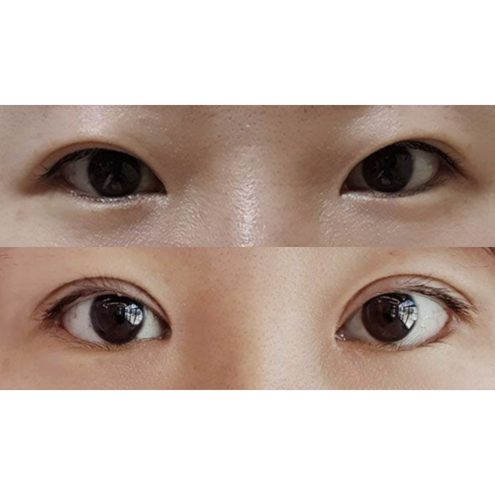 Mình đã phẫu thuật mắt được hơn một tháng rồi