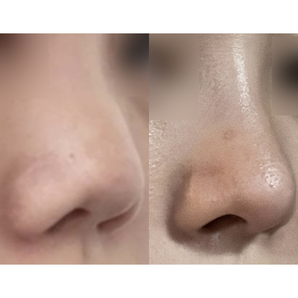 Mình đã phẫu thuật mũi được hơn một tháng rồi!