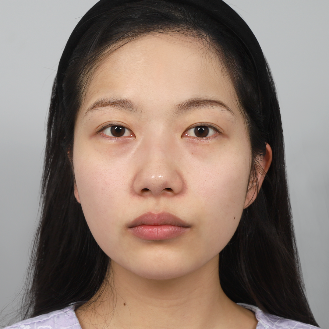 #Cắt mí một phần #Mở góc mắt trên #Nâng mũi không độn #Đầu mũi (sụn tự thân) #Chỉnh sửa mũi gồ Tái phẫu thuật mắt