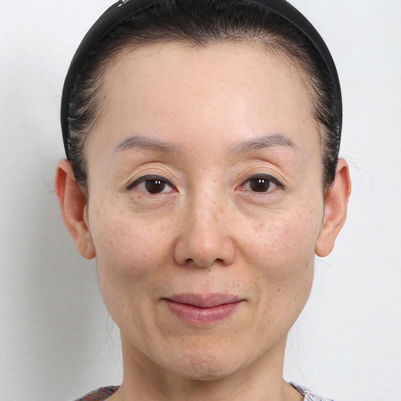 #Дээд зовхины өөх шилжүүлэн суулгах #Доод зовхины нүүрний өөх шилжүүлэн суулгах