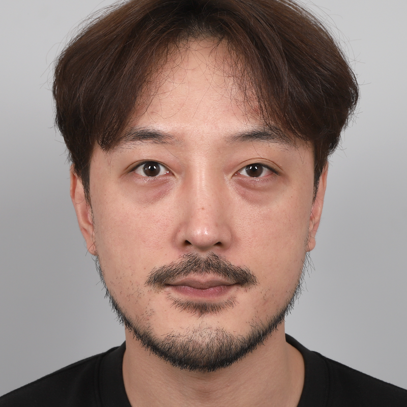 #Cắt mí một phần #Tái tạo bọng mắt dưới