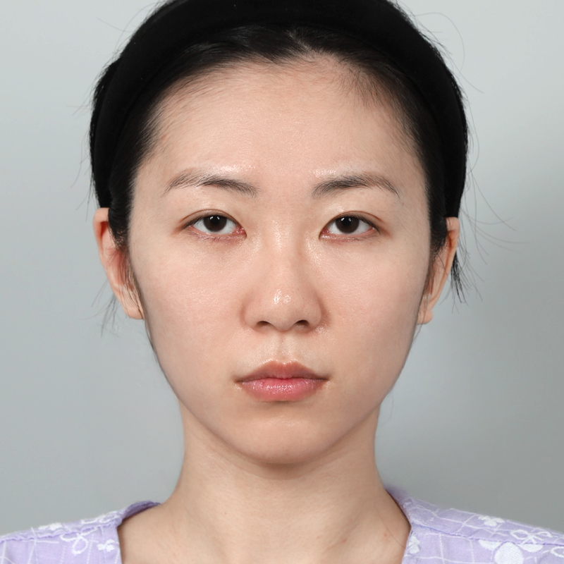 #Cấy_mỡ_mặt #Sống_mũi(silicone) #Đầu_mũi(sụn_tự_thân) #Phẫu_thuật_nâng_mũi_bằng_sụn_sườn_tự_thân_cấy_mỡ_toàn_mặt